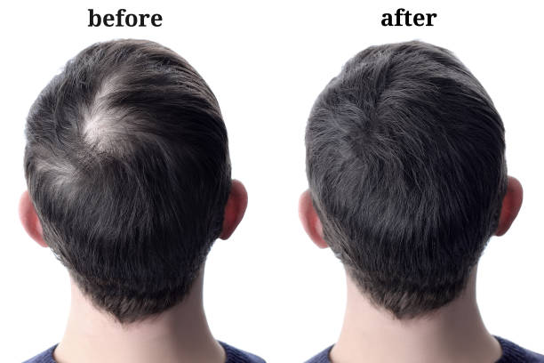 Crown area hair restoration