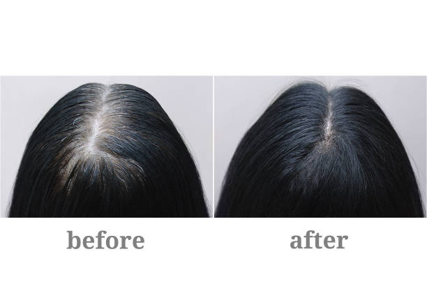 Women's hair transformation before and after using Halo Grow